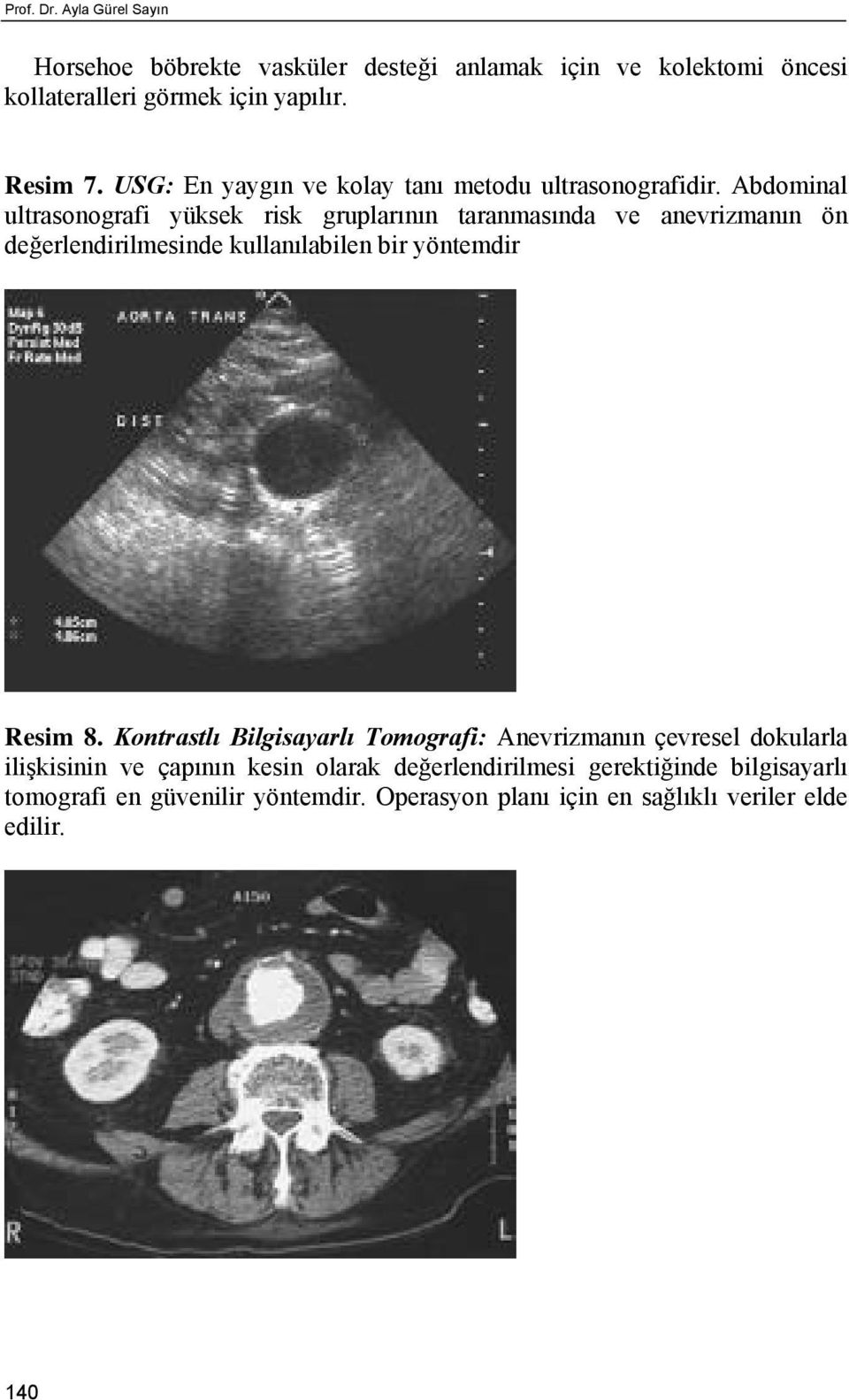 Abdominal ultrasonografi yüksek risk gruplarının taranmasında ve anevrizmanın ön değerlendirilmesinde kullanılabilen bir yöntemdir Re sim 8.