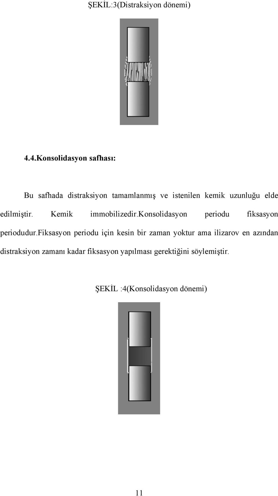 edilmiştir. Kemik immobilizedir.konsolidasyon periodu fiksasyon periodudur.