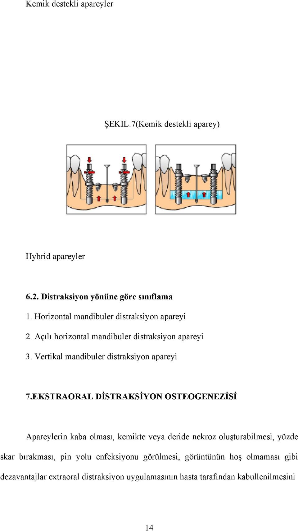 Vertikal mandibuler distraksiyon apareyi 7.