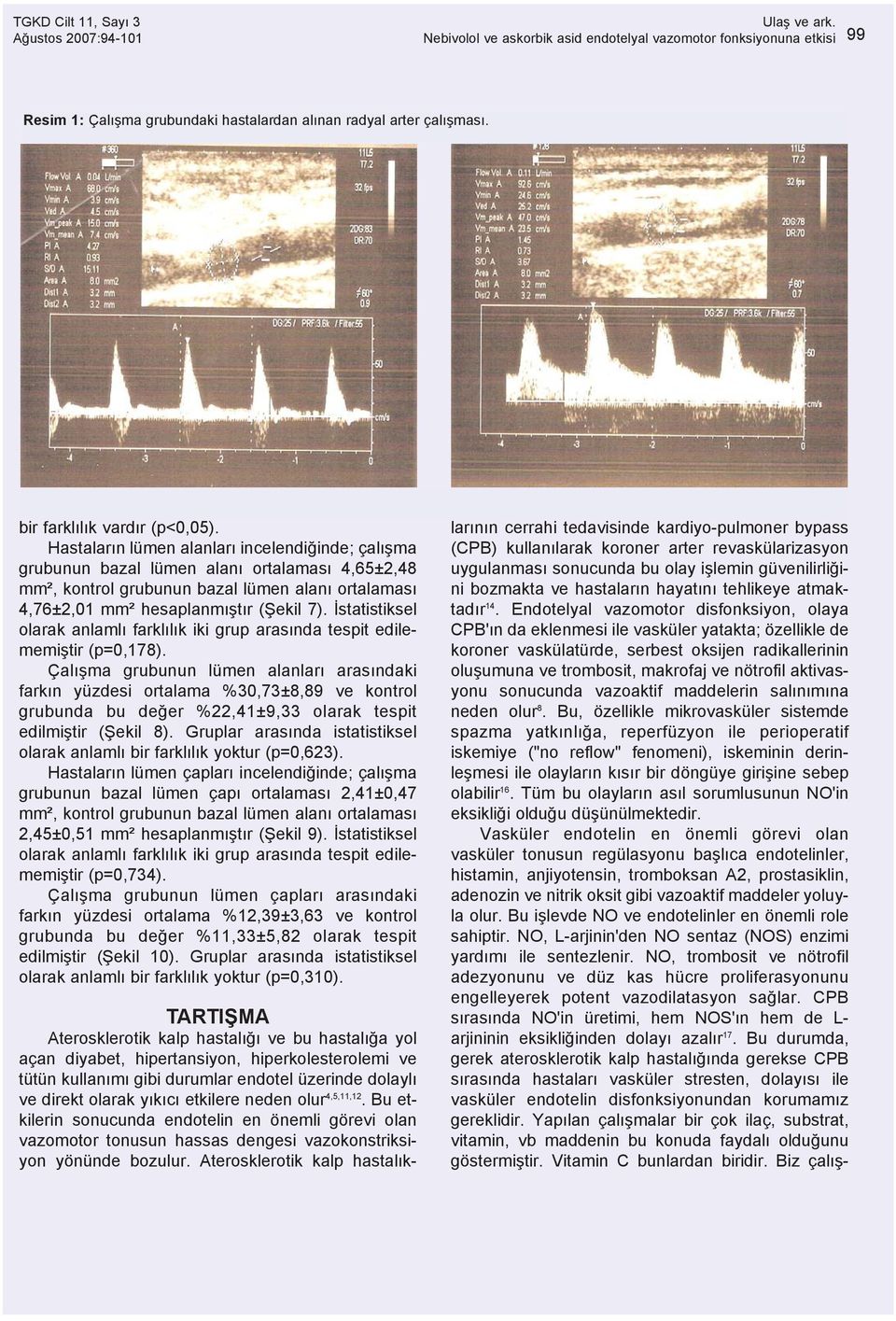 Hastalarýn lümen alanlarý incelendiðinde; çalýþma grubunun bazal lümen alaný ortalamasý 4,65±2,48 mm², nun bazal lümen alaný ortalamasý 4,76±2,01 mm² hesaplanmýþtýr (Þekil 7).