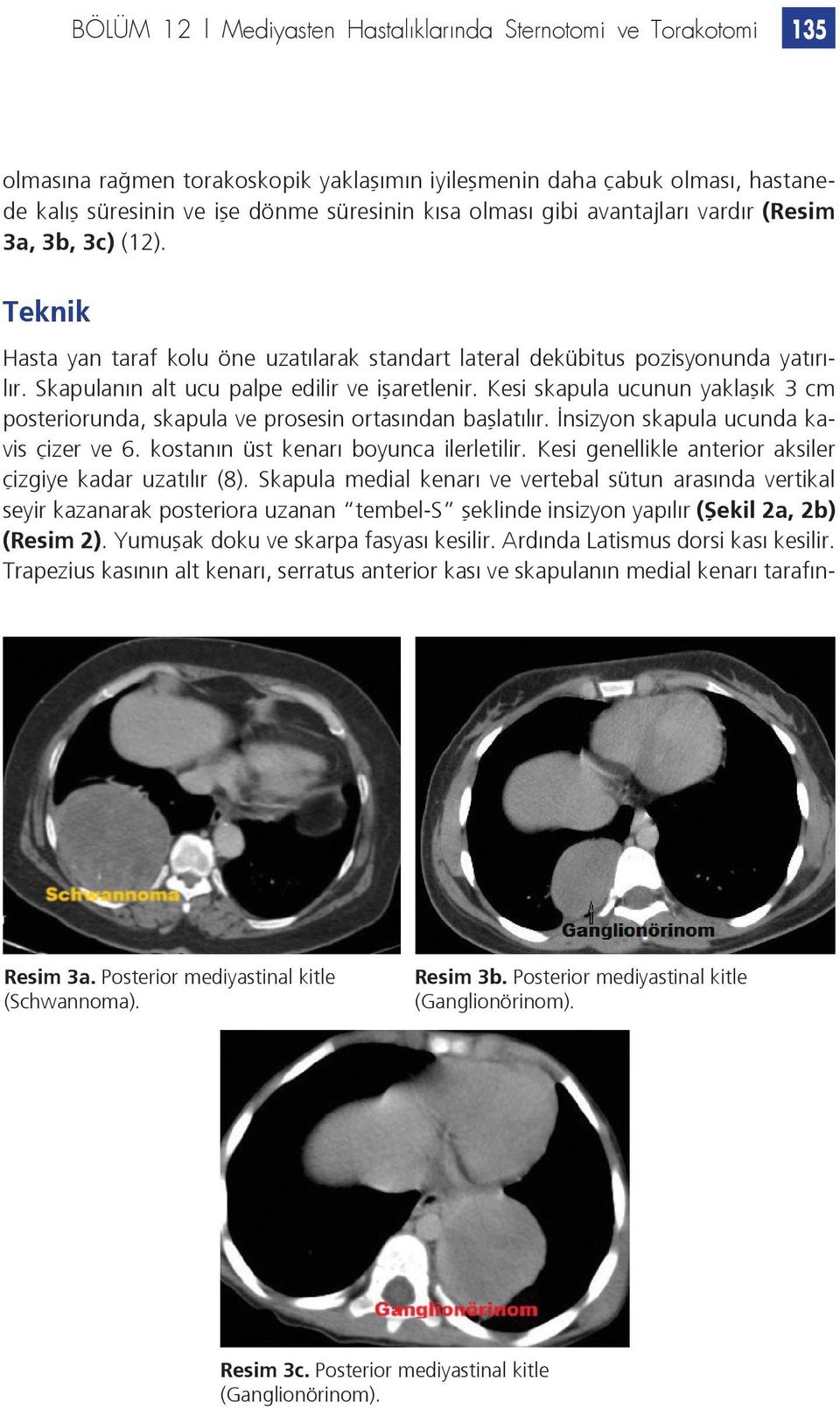 Kesi skapula ucunun yaklaşık 3 cm posteriorunda, skapula ve prosesin ortasından başlatılır. İnsizyon skapula ucunda kavis çizer ve 6. kostanın üst kenarı boyunca ilerletilir.