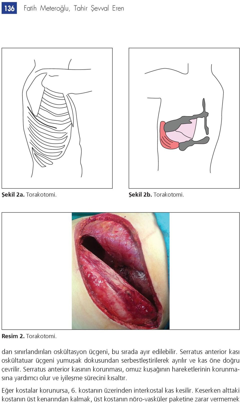 Serratus anterior kasının korunması, omuz kuşağının hareketlerinin korunmasına yardımcı olur ve iyileşme sürecini kısaltır.