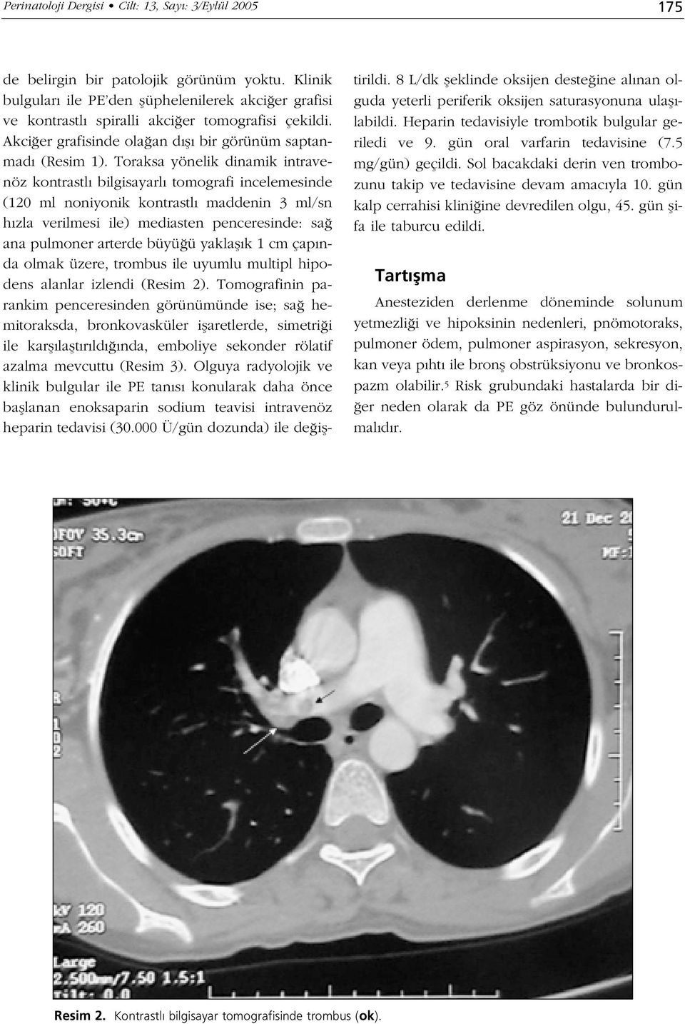 Toraksa yönelik dinamik intravenöz kontrastl bilgisayarl tomografi incelemesinde (120 ml noniyonik kontrastl maddenin 3 ml/sn h zla verilmesi ile) mediasten penceresinde: sa ana pulmoner arterde büyü