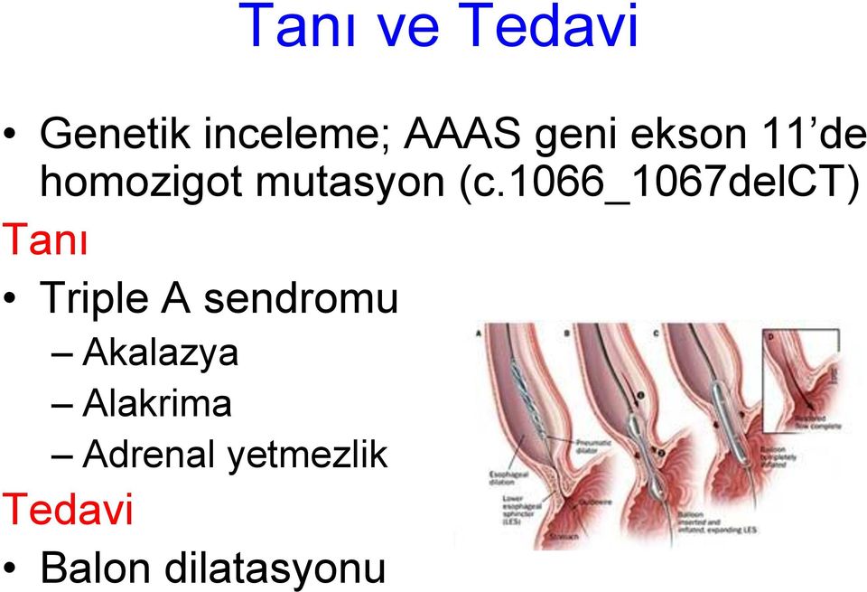 1066_1067delct) Tanı Triple A sendromu