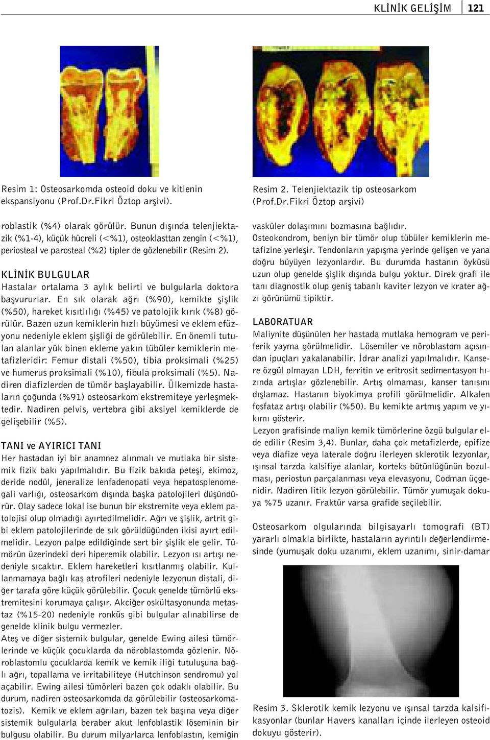 KL N K BULGULAR Hastalar ortalama 3 ayl k belirti ve bulgularla doktora baflvururlar. En s k olarak a r (%90), kemikte flifllik (%50), hareket k s tl l (%45) ve patolojik k r k (%8) görülür.