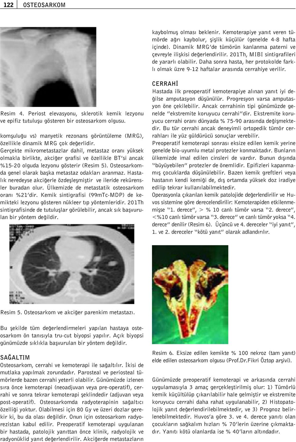 Daha sonra hasta, her protokolde farkl olmak üzre 9-12 haftalar aras nda cerrahiye verilir. Resim 4. Periost elevasyonu, sklerotik kemik lezyonu ve epifiz tutuluflu gösteren bir osteosarkom olgusu.