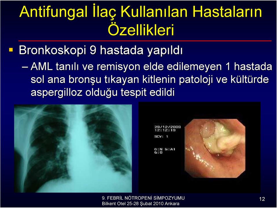 elde edilemeyen 1 hastada sol ana bronşu u tıkayan t