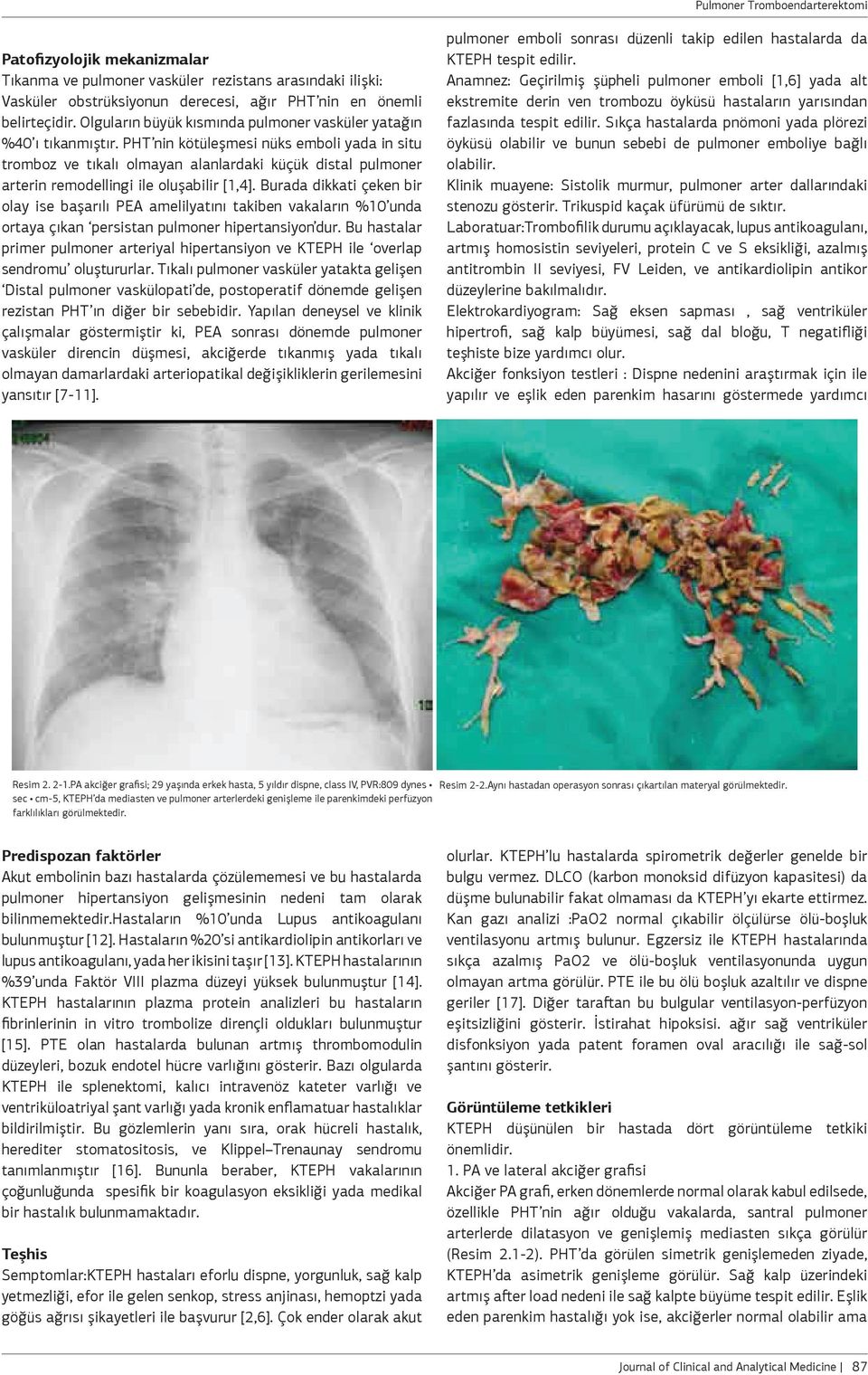 PHT nin kötüleşmesi nüks emboli yada in situ tromboz ve tıkalı olmayan alanlardaki küçük distal pulmoner arterin remodellingi ile oluşabilir [1,4].