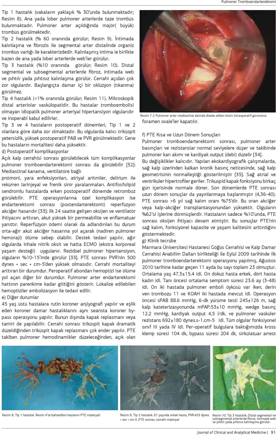 Kalınlaşmış intima ie birlikte bazen de ana yada lober arterlerde web ler görülür. Tip 3 hastalık (%10 oranında görülür; Resim 10).