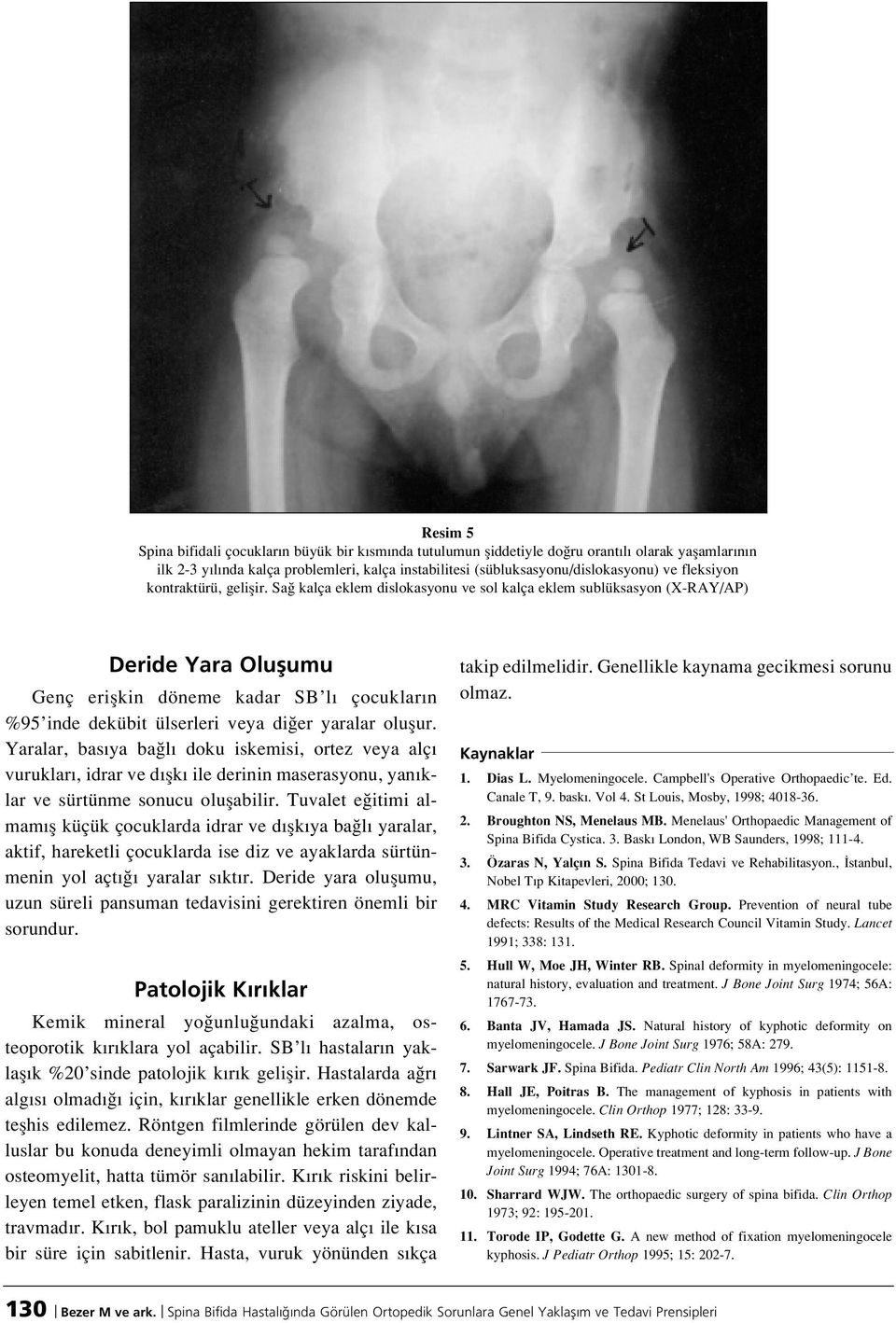 Sa kalça eklem dislokasyonu ve sol kalça eklem sublüksasyon (X-RAY/AP) Deride Yara Oluflumu Genç eriflkin döneme kadar SB l çocuklar n %95 inde dekübit ülserleri veya di er yaralar oluflur.