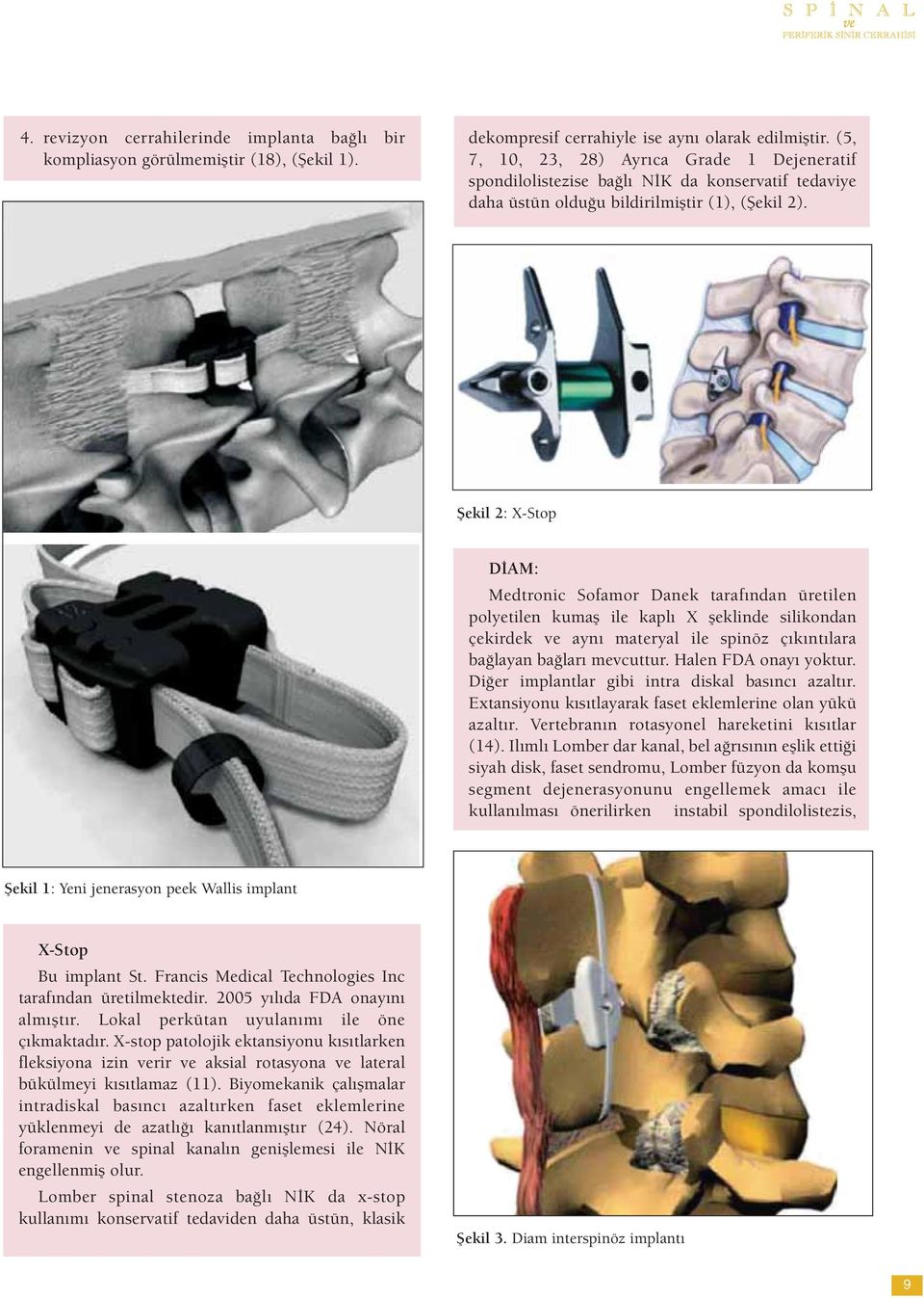 Şekil 2: X-Stop DİAM: Medtronic Sofamor Danek tarafından üretilen polyetilen kumaş ile kaplı X şeklinde silikondan çekirdek ve aynı materyal ile spinöz çıkıntılara bağlayan bağları mevcuttur.