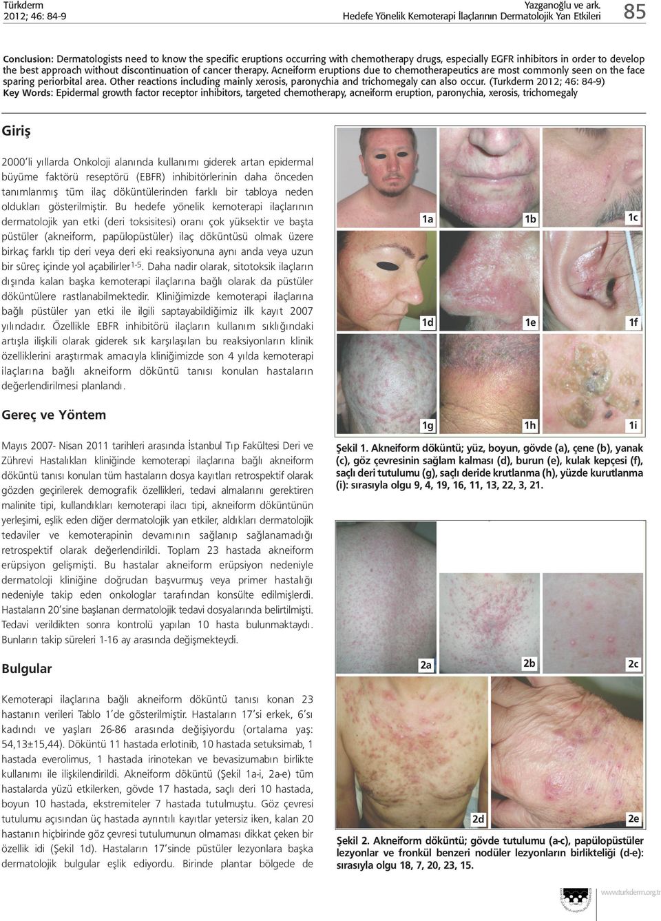 Acneiform eruptions due to chemotherapeutics are most commonly seen on the face sparing periorbital area. Other reactions including mainly xerosis, paronychia and trichomegaly can also occur.