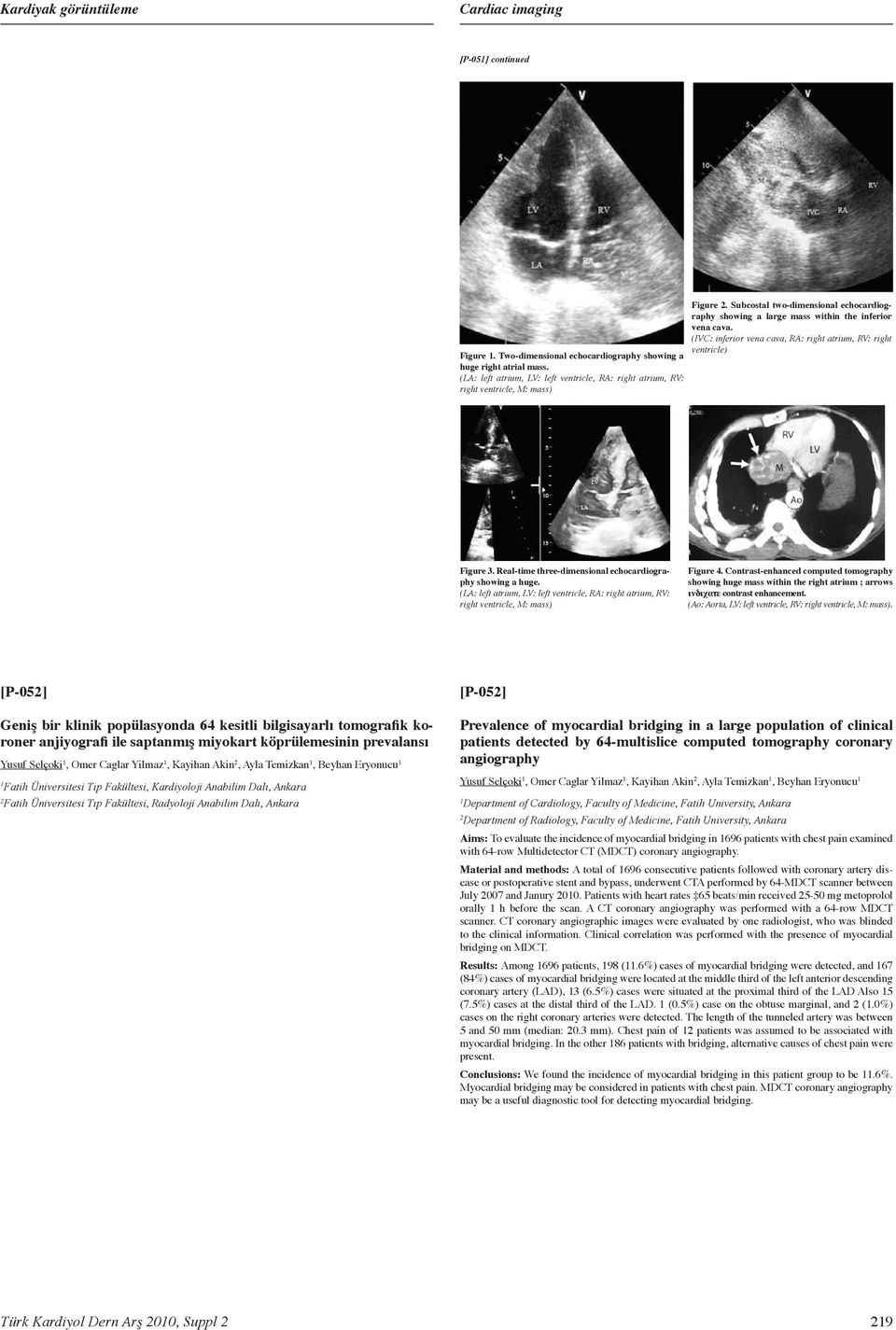 (IVC: inferior vena cava, RA: right atrium, RV: right ventricle) Figure 3. Real-time three-dimensional echocardiography showing a huge.