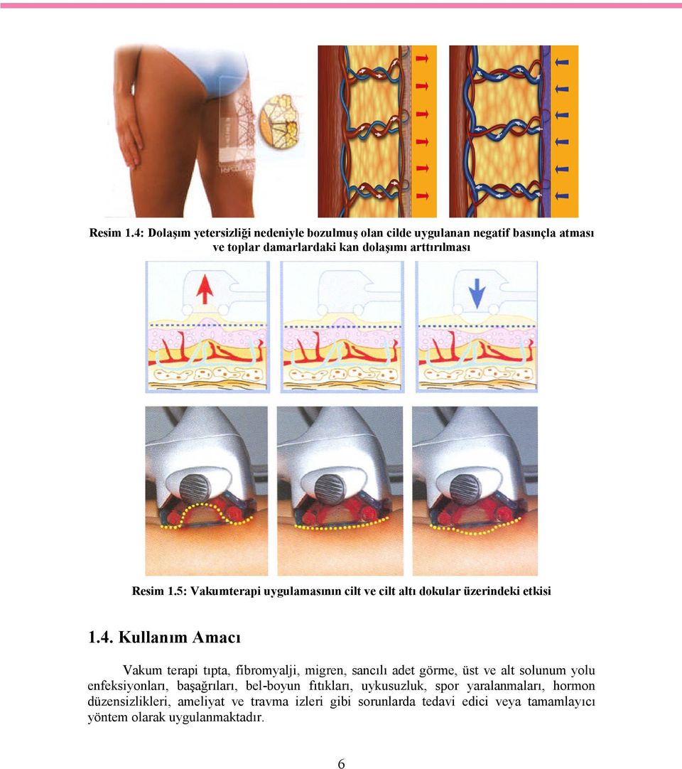 arttırılması 5: Vakumterapi uygulamasının cilt ve cilt altı dokular üzerindeki etkisi 1.4.