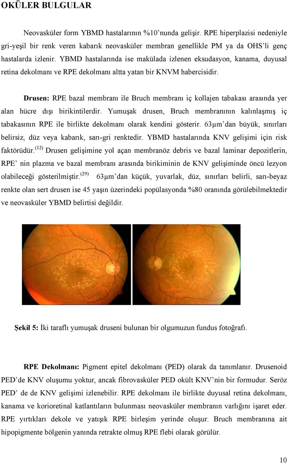 YBMD hastalarında ise makülada izlenen eksudasyon, kanama, duyusal retina dekolmanı ve RPE dekolmanı altta yatan bir KNVM habercisidir.