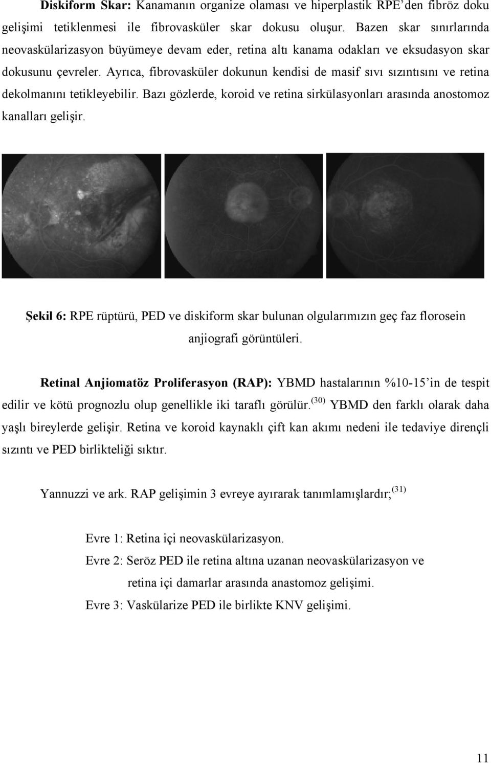 Ayrıca, fibrovasküler dokunun kendisi de masif sıvı sızıntısını ve retina dekolmanını tetikleyebilir. Bazı gözlerde, koroid ve retina sirkülasyonları arasında anostomoz kanalları gelişir.