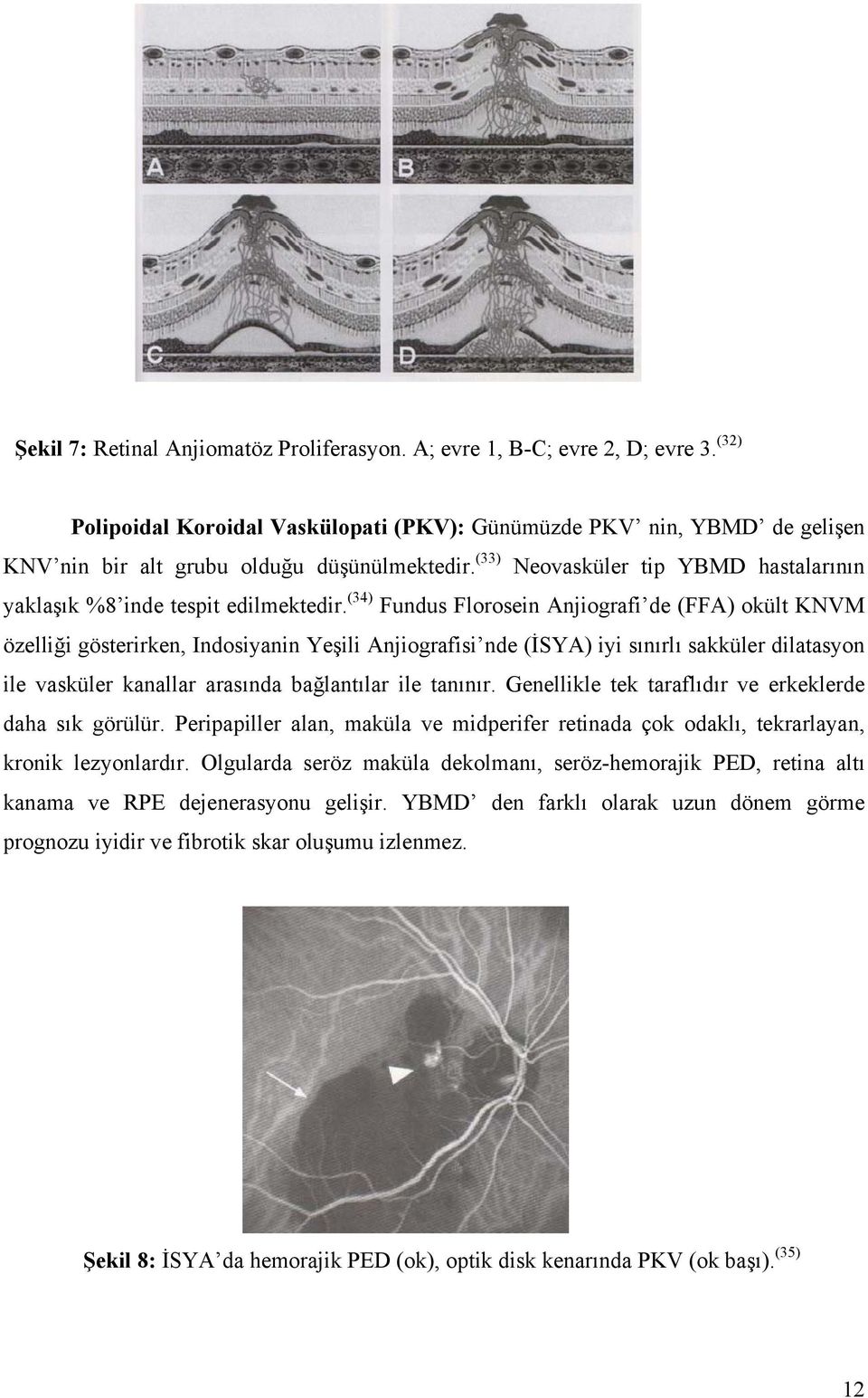 (33) Neovasküler tip YBMD hastalarının yaklaşık %8 inde tespit edilmektedir.