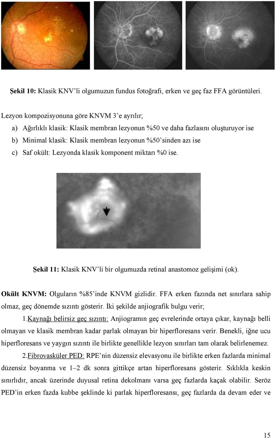 okült: Lezyonda klasik komponent miktarı %0 ise. Şekil 11: Klasik KNV li bir olgumuzda retinal anastomoz gelişimi (ok). Okült KNVM: Olguların %85 inde KNVM gizlidir.