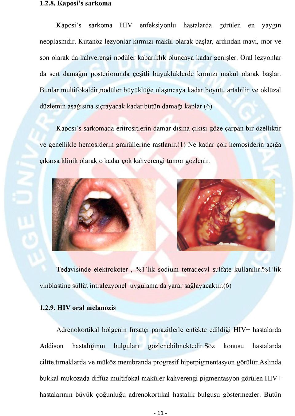 Oral lezyonlar da sert damağın posteriorunda çeşitli büyüklüklerde kırmızı makül olarak başlar.