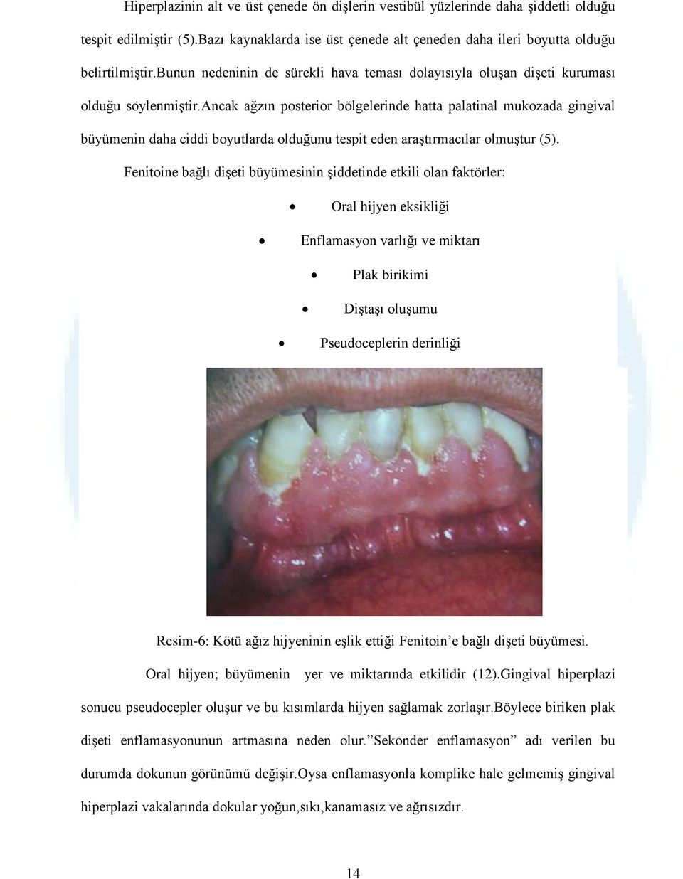 ancak ağzın posterior bölgelerinde hatta palatinal mukozada gingival büyümenin daha ciddi boyutlarda olduğunu tespit eden araştırmacılar olmuştur (5).
