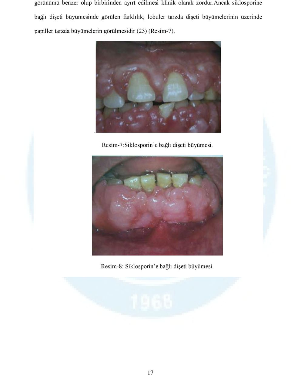 dişeti büyümelerinin üzerinde papiller tarzda büyümelerin görülmesidir (23)