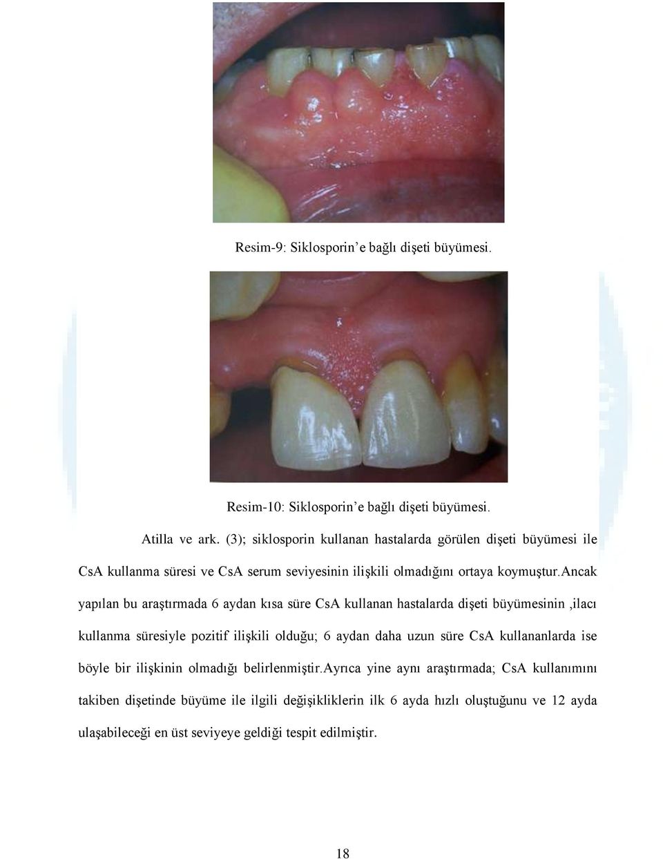 ancak yapılan bu araştırmada 6 aydan kısa süre CsA kullanan hastalarda dişeti büyümesinin,ilacı kullanma süresiyle pozitif ilişkili olduğu; 6 aydan daha uzun süre CsA