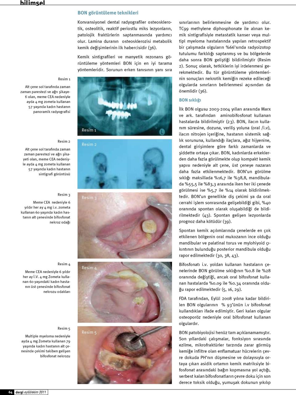 V. 4 mg Zometa kullanan 60 yaşındaki kadın hastanın üst çenesinde bifosfonat nekrozu odakları Resim 5 Multiple myeloma nedeniyle ayda 4 mg Zometa kullanan 79 yaşında kadın hastanın alt çenesinde