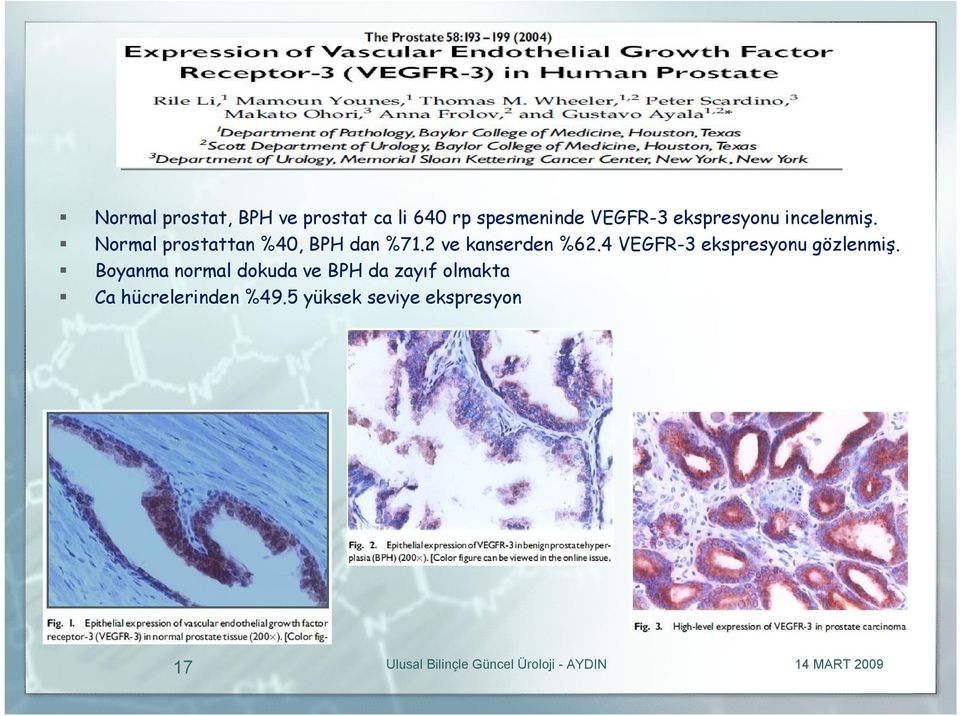 2 ve kanserden %62.4 VEGFR-3 ekspresyonu gözlenmiş.
