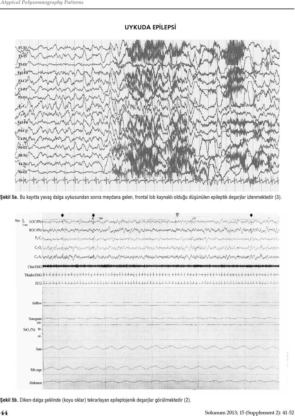 Bu kayıtta yavaş dalga uykusundan sonra meydana gelen, frontal lob kaynaklı olduğu düşünülen epileptik deşarjlar