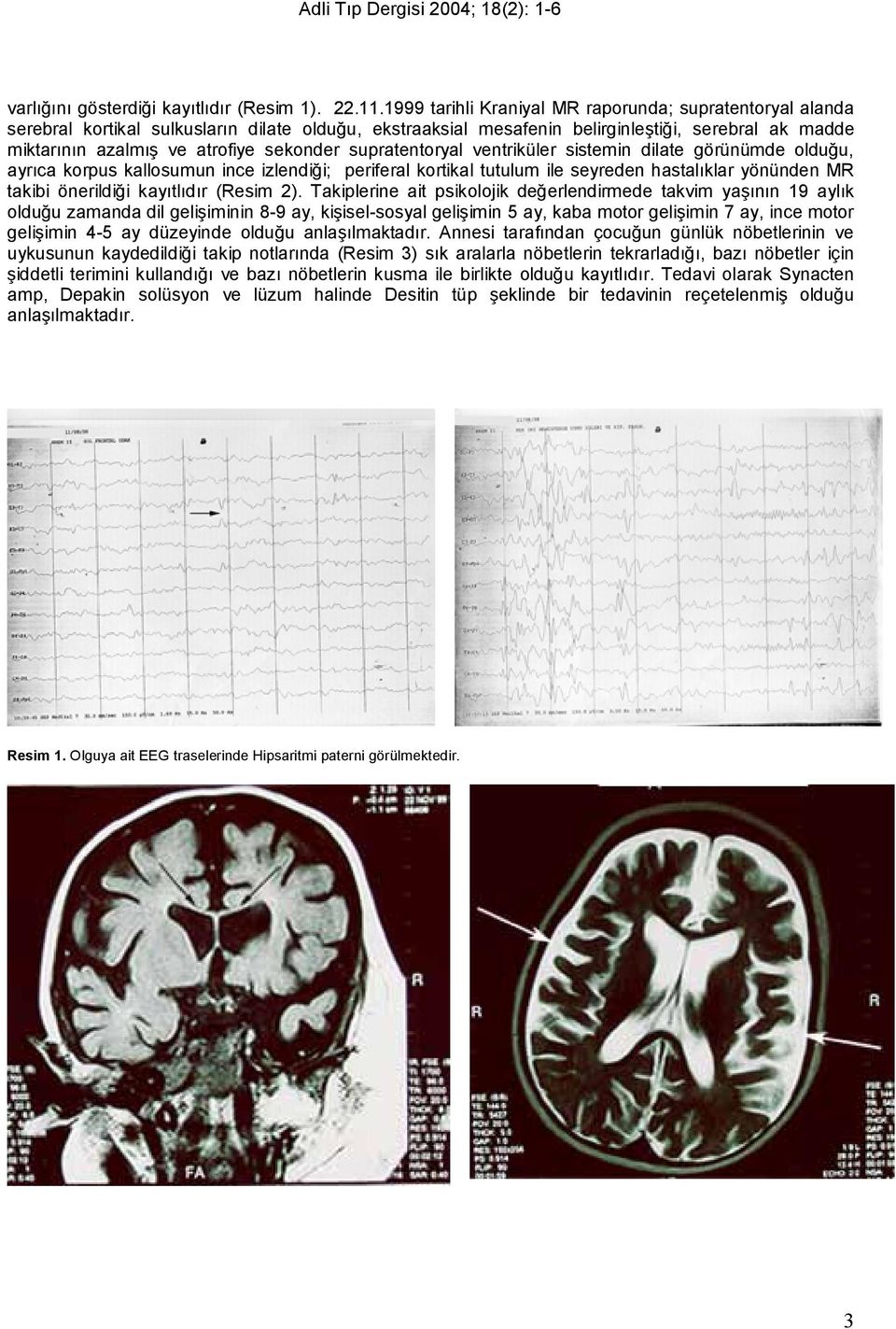 sekonder supratentoryal ventriküler sistemin dilate görünümde olduğu, ayrıca korpus kallosumun ince izlendiği; periferal kortikal tutulum ile seyreden hastalıklar yönünden MR takibi önerildiği