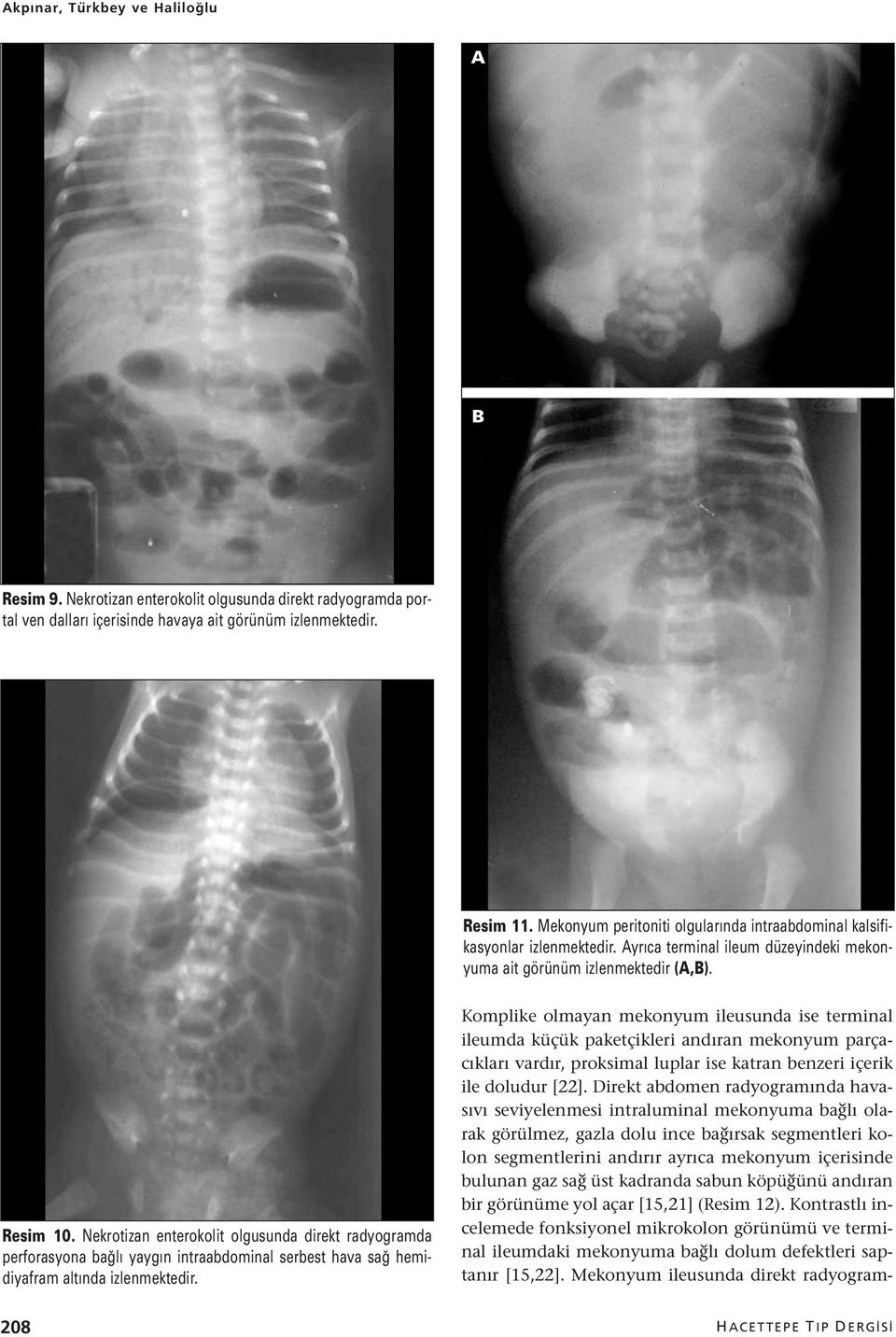 Nekrotizan enterokolit olgusunda direkt radyogramda perforasyona bağlı yaygın intraabdominal serbest hava sağ hemidiyafram altında izlenmektedir.