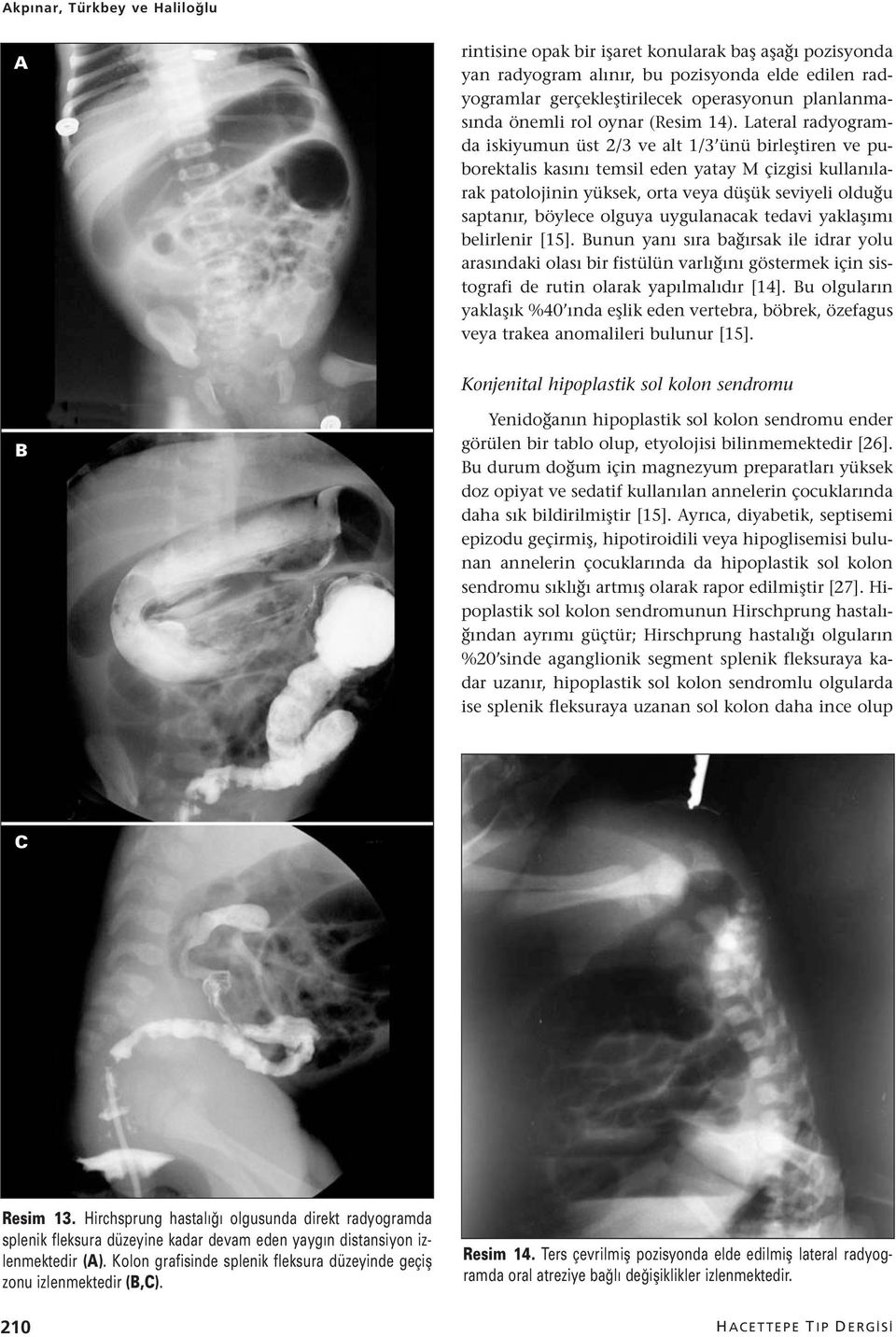 Lateral radyogramda iskiyumun üst 2/3 ve alt 1/3 ünü birleştiren ve puborektalis kasını temsil eden yatay M çizgisi kullanılarak patolojinin yüksek, orta veya düşük seviyeli olduğu saptanır, böylece