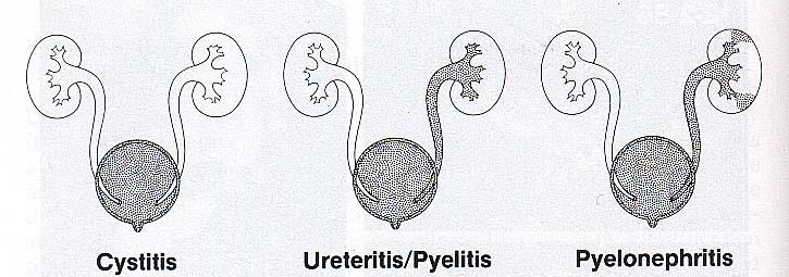 1) KOMPLİKE OLMAYAN ALT İYE - Sistit - Üretrit 2) KOMPLİKE OLMAYAN ÜST İYE - Üreterit - Piyelit 3) BÖBREK PARANKİMİ