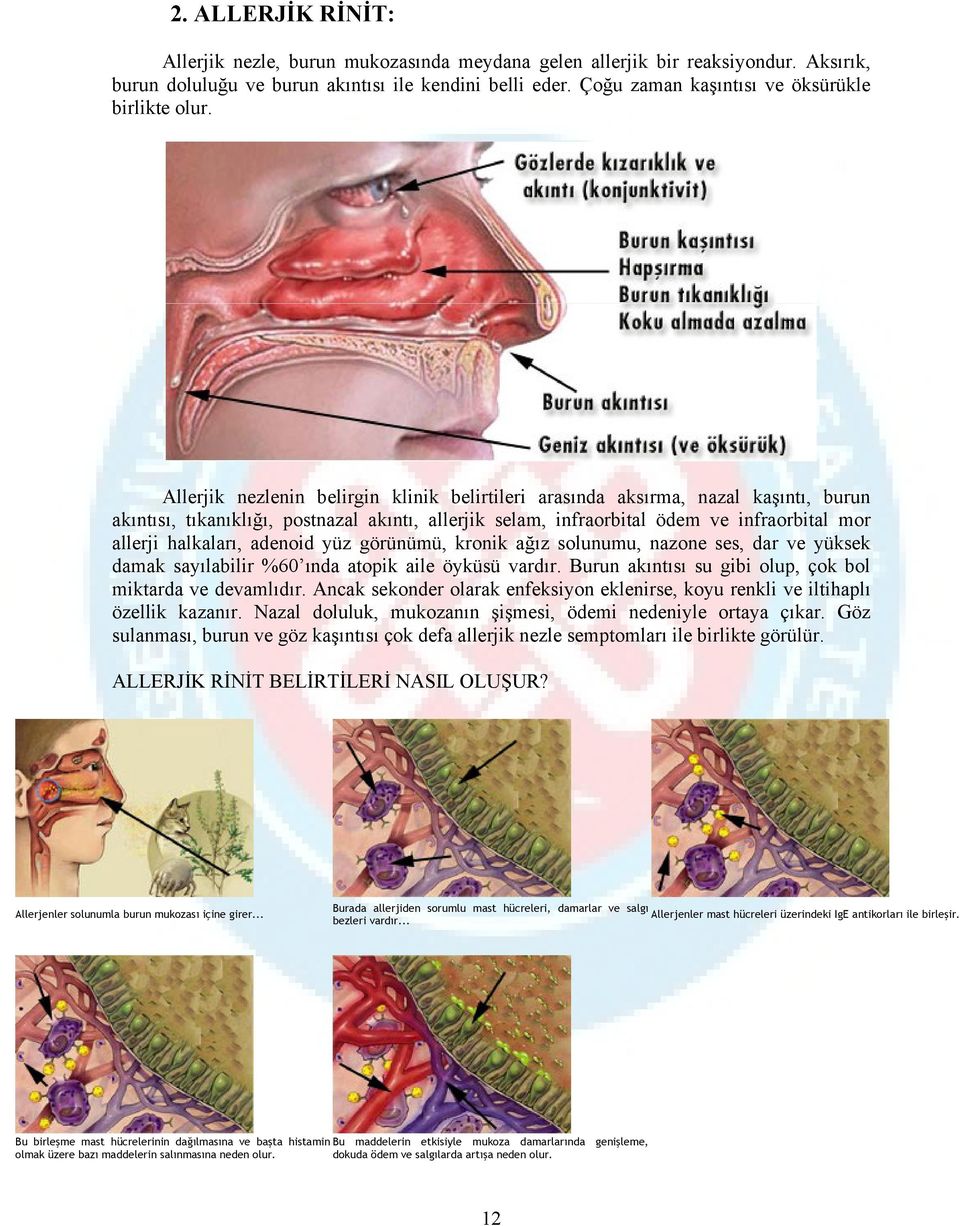 Allerjik nezlenin belirgin klinik belirtileri arasında aksırma, nazal kaşıntı, burun akıntısı, tıkanıklığı, postnazal akıntı, allerjik selam, infraorbital ödem ve infraorbital mor allerji halkaları,