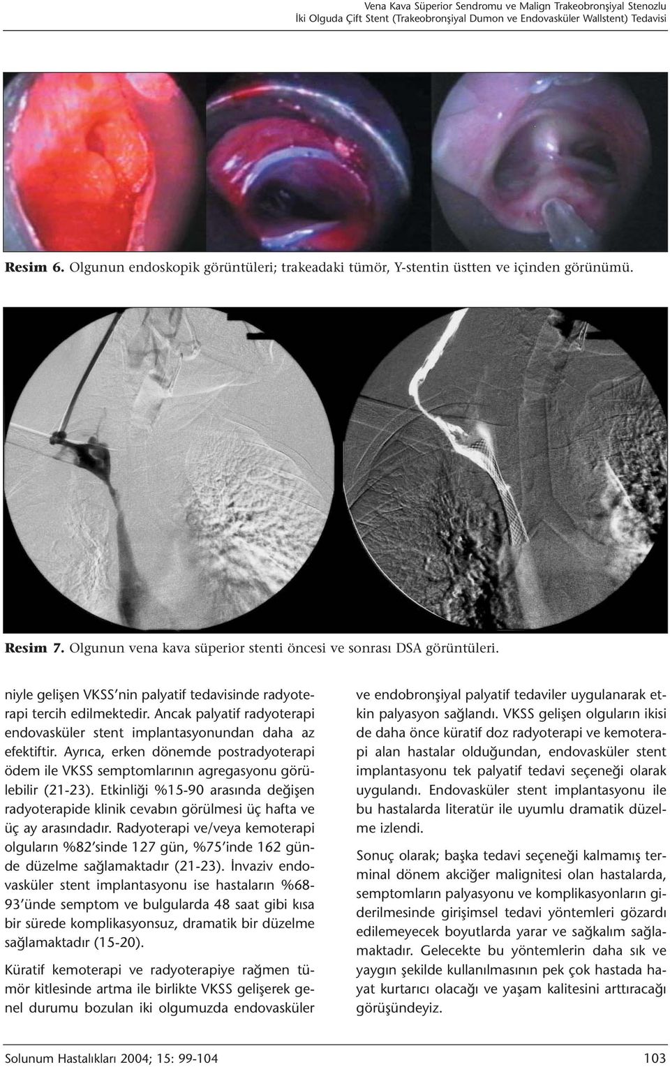 niyle gelişen VKSS nin palyatif tedavisinde radyoterapi tercih edilmektedir. Ancak palyatif radyoterapi endovasküler stent implantasyonundan daha az efektiftir.