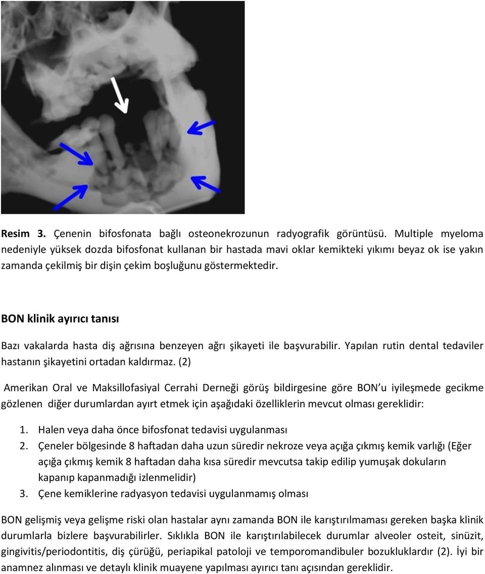 BON klinik ayırıcı tanısı Bazı vakalarda hasta diş ağrısına benzeyen ağrı şikayeti ile başvurabilir. Yapılan rutin dental tedaviler hastanın şikayetini ortadan kaldırmaz.