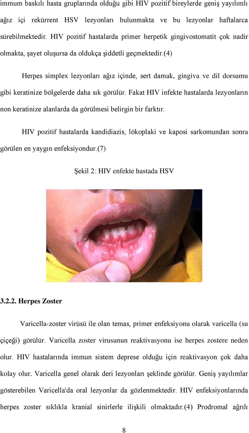 (4) Herpes simplex lezyonları ağız içinde, sert damak, gingiva ve dil dorsumu gibi keratinize bölgelerde daha sık görülür.