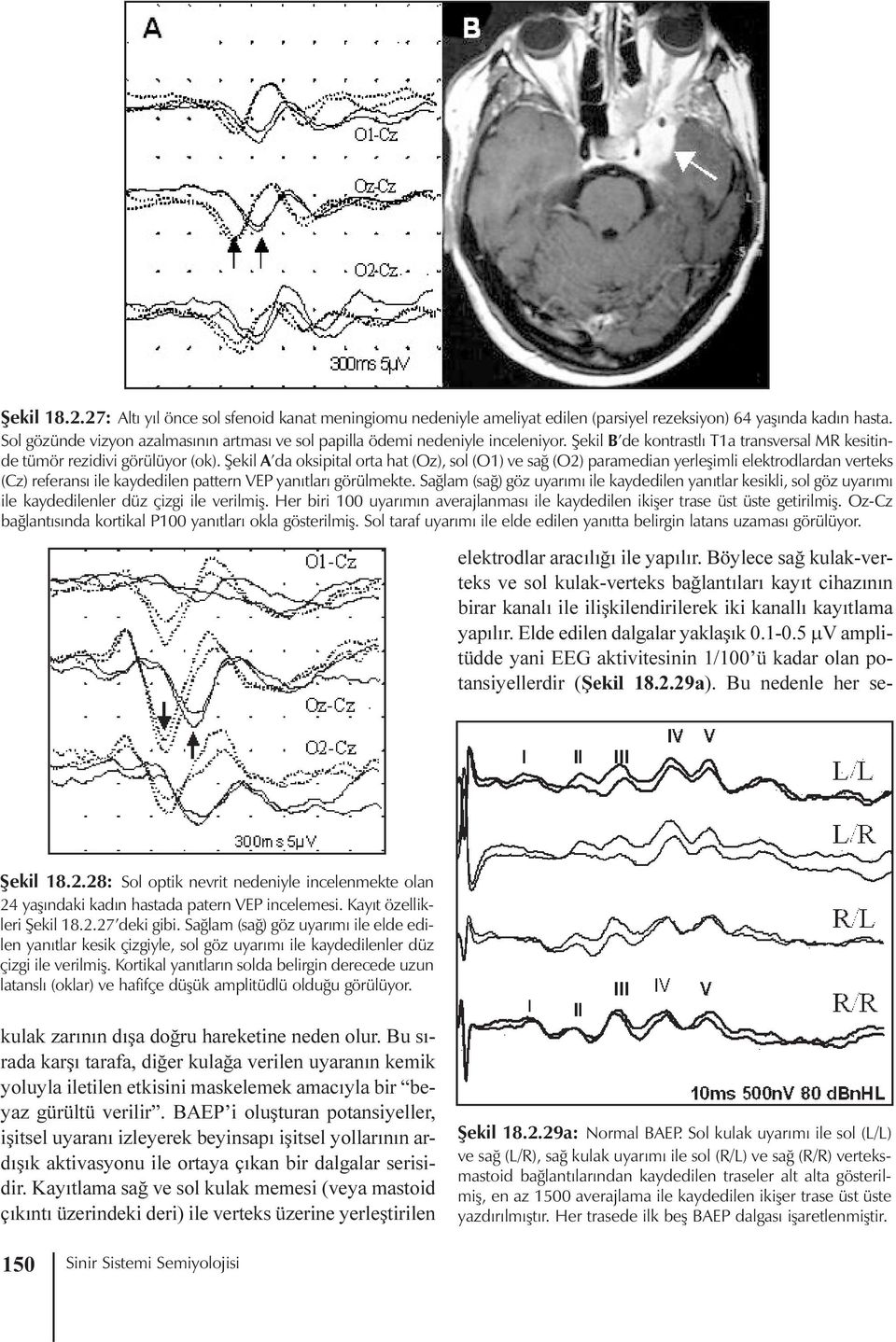 Þekil A da oksipital orta hat (Oz), sol (O1) ve sað (O2) paramedian yerleþimli elektrodlardan verteks (Cz) referansý ile kaydedilen pattern VEP yanýtlarý görülmekte.