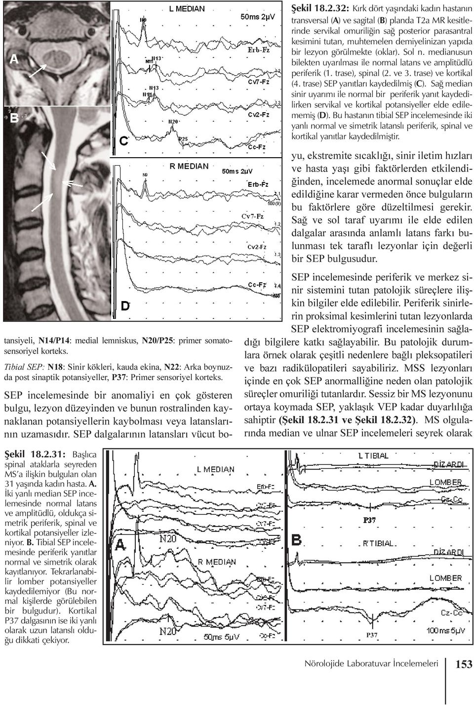 lezyon görülmekte (oklar). Sol n. medianusun bilekten uyarýlmasý ile normal latans ve amplitüdlü periferik (1. trase), spinal (2. ve 3. trase) ve kortikal (4. trase) SEP yanýtlarý kaydedilmiþ (C).