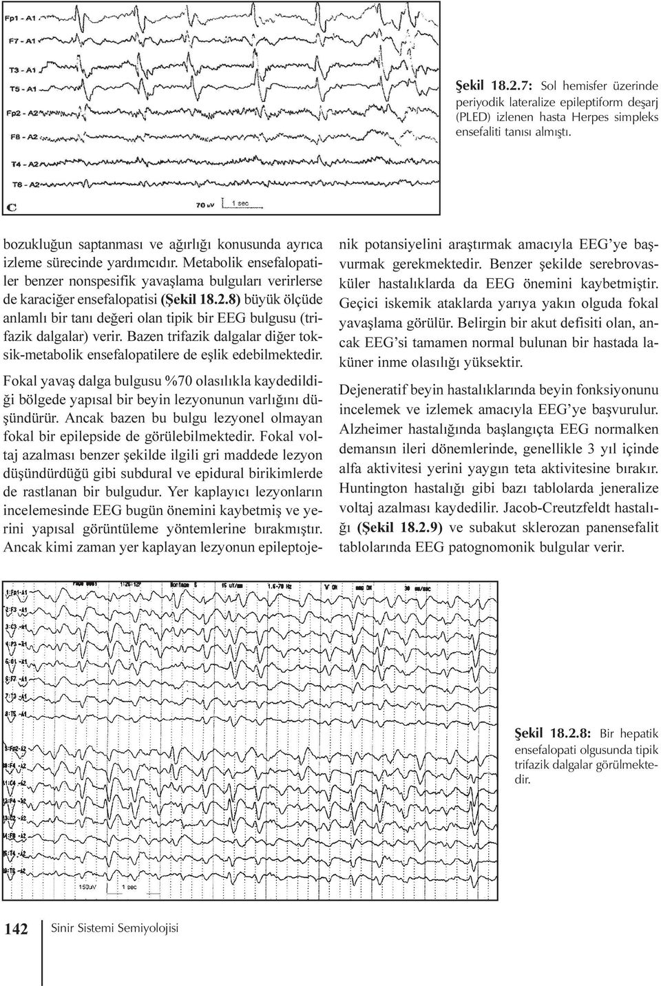 8) büyük ölçüde anlamlý bir taný deðeri olan tipik bir EEG bulgusu (trifazik dalgalar) verir. Bazen trifazik dalgalar diðer toksik-metabolik ensefalopatilere de eþlik edebilmektedir.