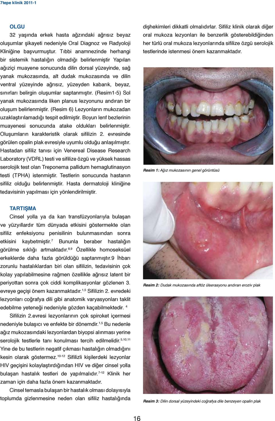 yüzeyinde ağrısız, yüzeyden kabarık, beyaz, sınırları belirgin oluşumlar saptanmıştır. (Resim1-5) Sol yanak mukozasında liken planus lezyonunu andıran bir oluşum belirlenmiştir.