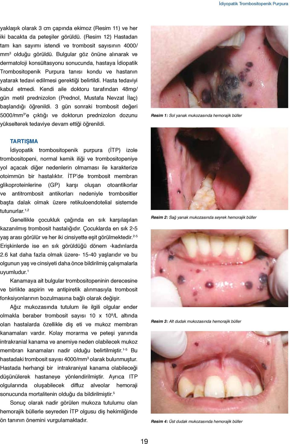 Bulgular göz önüne alınarak ve dermatoloji konsültasyonu sonucunda, hastaya İdiopatik Trombositopenik Purpura tanısı kondu ve hastanın yatarak tedavi edilmesi gerektiği belirtildi.