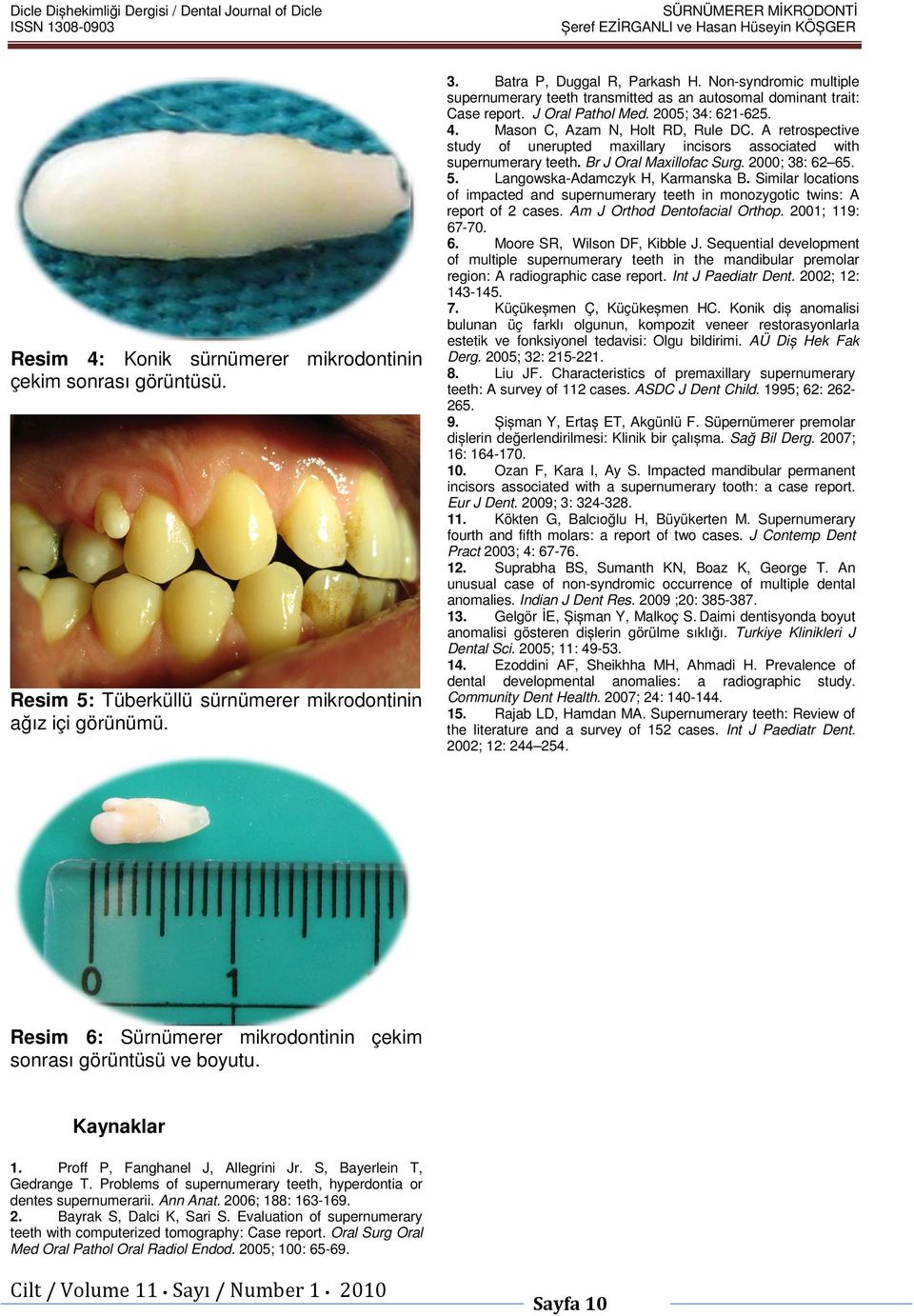 J Oral Pathol Med. 2005; 34: 621-625. 4. Mason C, Azam N, Holt RD, Rule DC. A retrospective study of unerupted maxillary incisors associated with supernumerary teeth. Br J Oral Maxillofac Surg.