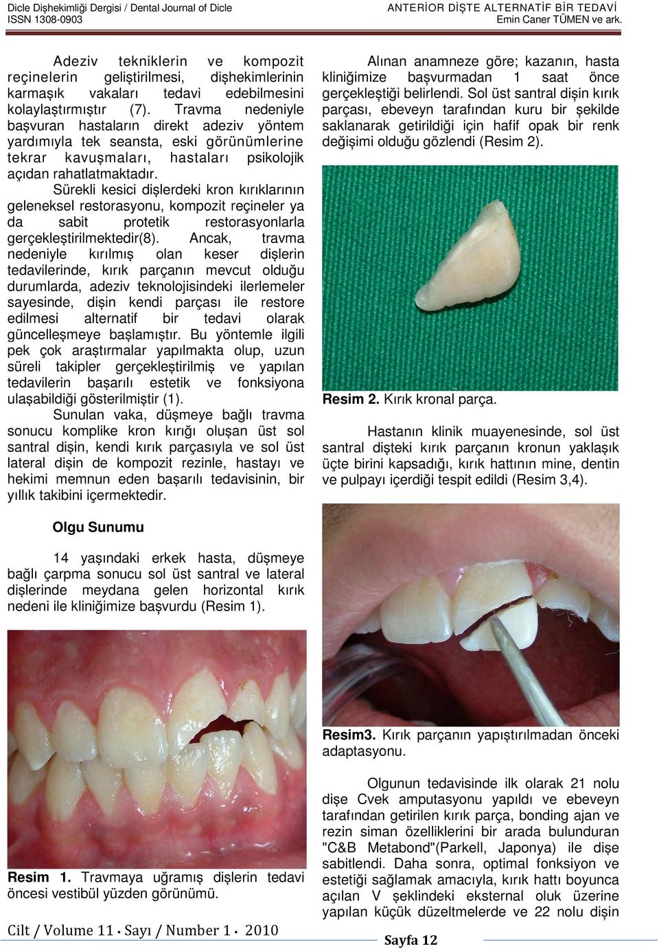 Travma nedeniyle bașvuran hastaların direkt adeziv yöntem yardımıyla tek seansta, eski görünümlerine tekrar kavușmaları, hastaları psikolojik açıdan rahatlatmaktadır.