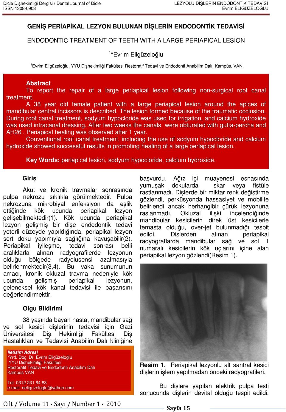 Abstract To report the repair of a large periapical lesion following non-surgical root canal treatment.