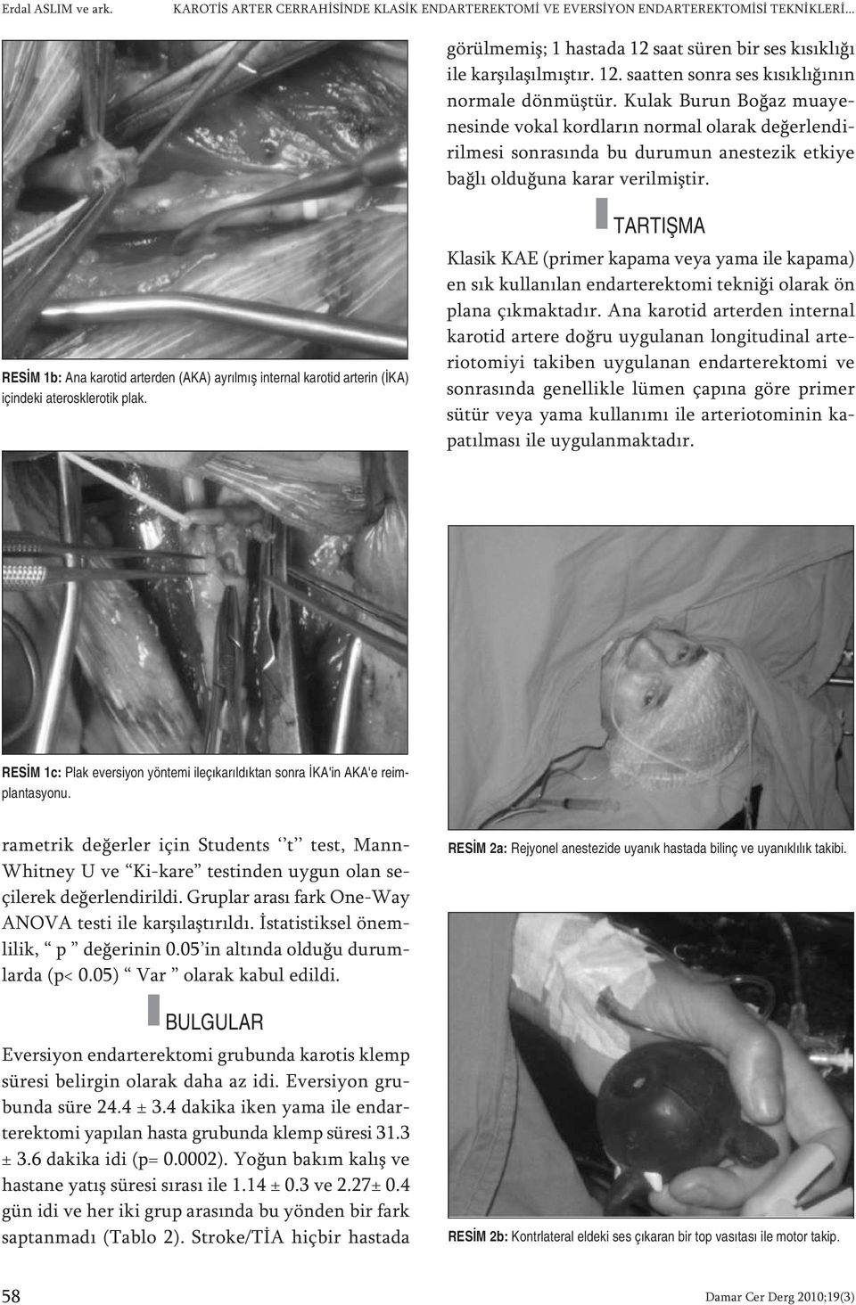 RE SİM 1b: Ana karotid arterden (AKA) ayrılmış internal karotid arterin (İKA) içindeki aterosklerotik plak.