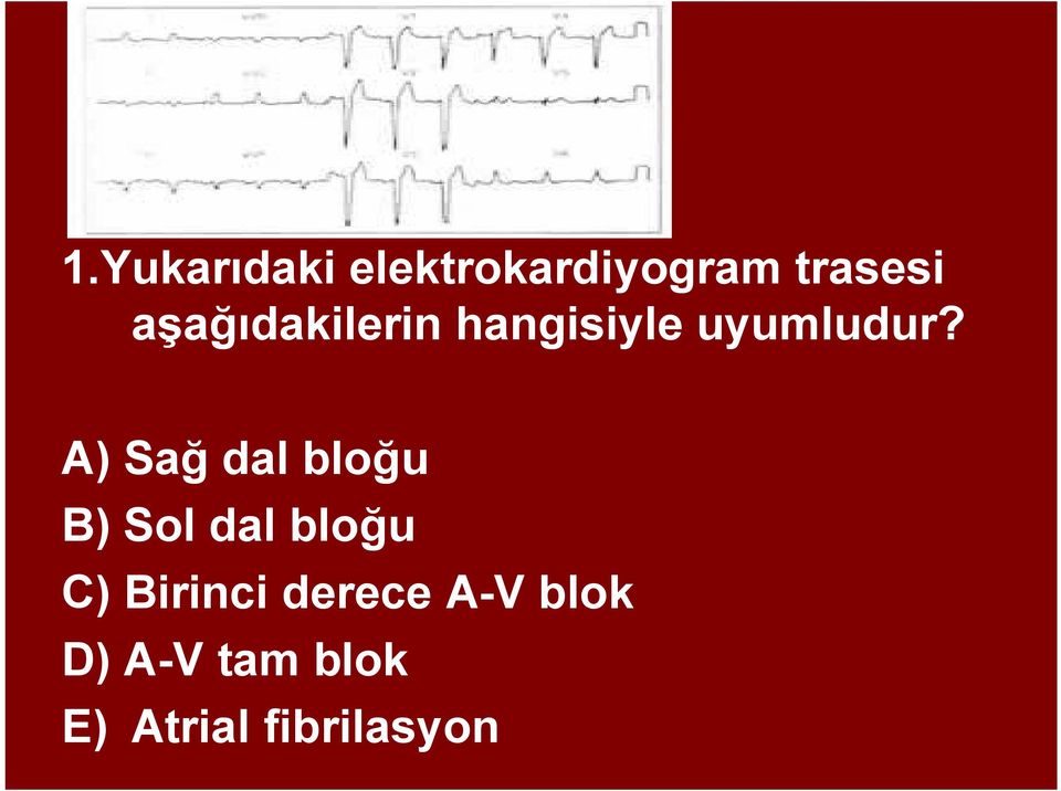 A) Sağ dal bloğu B) Sol dal bloğu C)