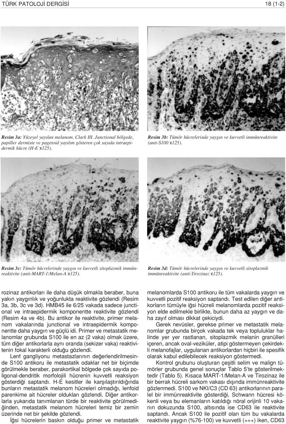 Resim 3d: Tümör hücrelerinde yayg n ve kuvvetli sitoplazmik immünreaktivite (anti-tirozinaz x125).