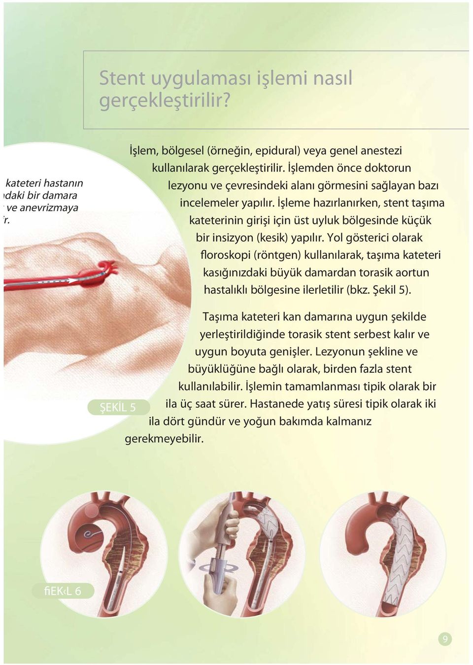 İşleme hazırlanırken, stent taşıma kateterinin girişi için üst uyluk bölgesinde küçük bir insizyon (kesik) yapılır.