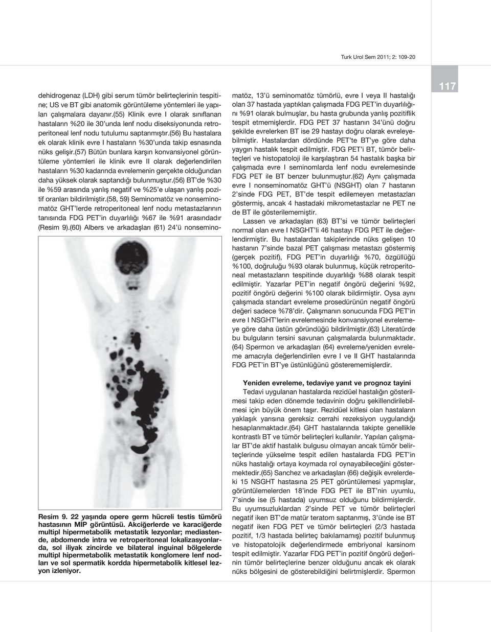 multipl hipermetabolik metastatik konglomere lenf nodları ve sol spermatik kordda hipermetabolik kitlesel lezyon izleniyor.